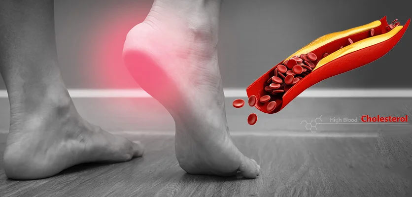 کلسترول بالا و درد پاشنه پا: بررسی ارتباط، علائم و روش درمان